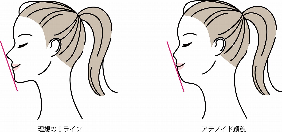 口ゴボ(出っ歯)とは